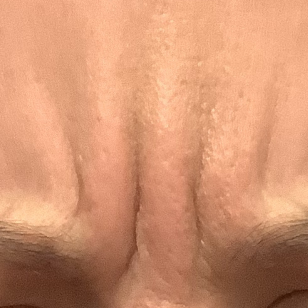 11's Before Botox