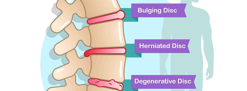 Illustration of a spine demonstrating an example of what a bulging, herniated, and degenerative disc look like