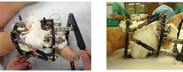 **Alt Text**: "Imagem de um médico fazendo ajustes e apertos no aparelho de Ilizarov. A imagem ilustra como o dispositivo é ajustado ao longo do tempo, permitindo a modificação controlada da tensão e do comprimento, facilitando a cicatrização óssea e a correção de deformidades."