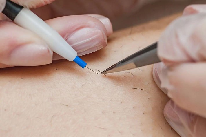 Electrolysis permanent hair removal ازالة الشعر بالالكترولايزس