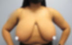 Breast Reduction Before
