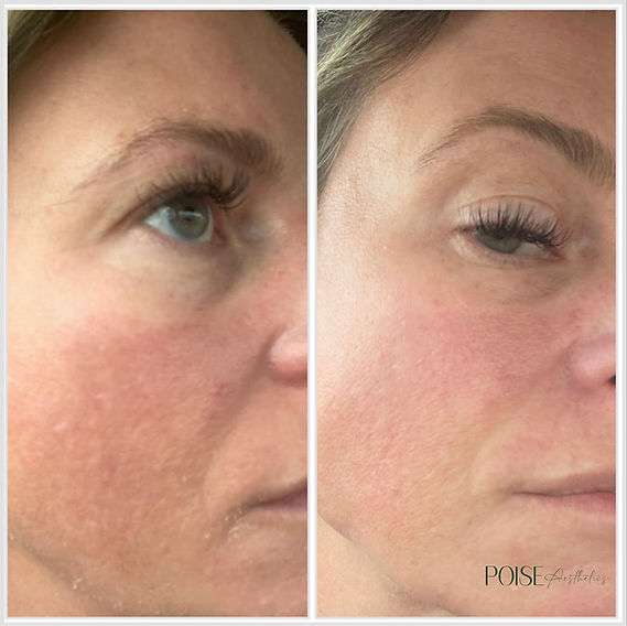 before and after skin treatment