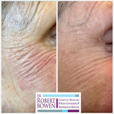 'Tox' wrinkle-reducing injection Before & After by Dr. Robert Bowen