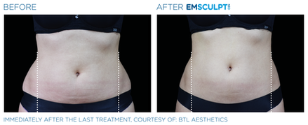 Emsculpt NEO Before & After (Images courtesy BTL Aesthetics)