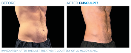 Emsculpt NEO Before & After (Images courtesy BTL Aesthetics)