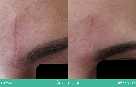 Secret RF
Before & Afters
(Images courtesy Cutera)
