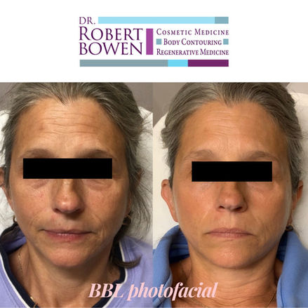 BBL Before & After by Dr. Robert Bowen