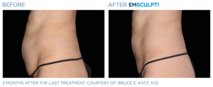 Emsculpt_neo_PIC_Ba-card-female-abdomen-006_ENUS100.png