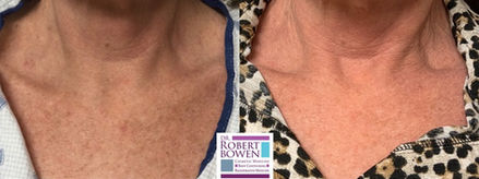 BBL Before & After by Dr. Robert Bowen