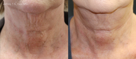 Secret RF
Before & Afters
(Images courtesy Cutera)