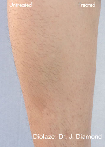 diolazexl-before-after-dr-j-diamond-preview-4.jpg