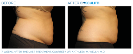 Emsculpt NEO Before & After (Images courtesy BTL Aesthetics)