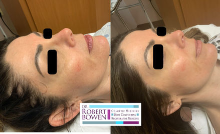 BBL Before & After by Dr. Robert Bowen