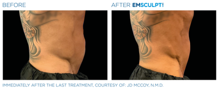 Emsculpt NEO Before & After (Images courtesy BTL Aesthetics)