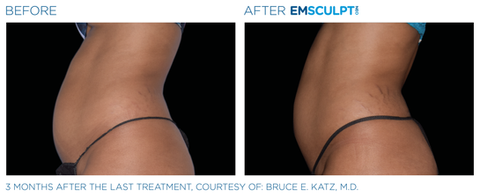 Emsculpt NEO Before & After (Images courtesy BTL Aesthetics)