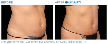 Emsculpt NEO Before & After (Images courtesy BTL Aesthetics)