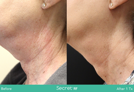 Secret RF Before & Afters
(Images courtesy Cutera)