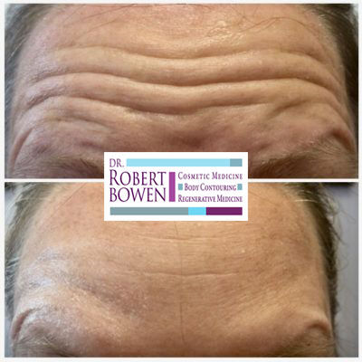 'Tox' wrinkle-reducing injection Before & After by Dr. Robert Bowen