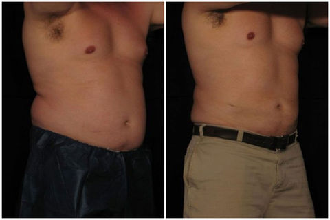 Liposuction before and after
