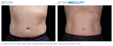 Emsculpt NEO Before & After (Images courtesy BTL Aesthetics)