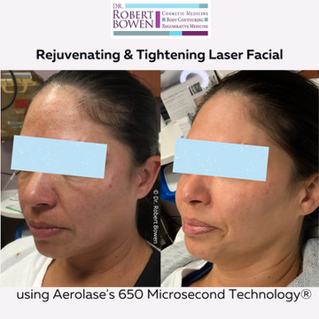 Rejuvenating-Tightening-Laser-Facial-6-1.png