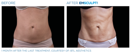 Emsculpt NEO Before & After (Images courtesy BTL Aesthetics)