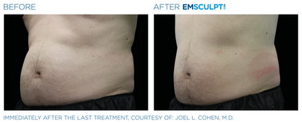 Emsculpt NEO Before & After (Images courtesy BTL Aesthetics)