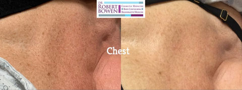 BBL Before & After by Dr. Robert Bowen