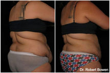 Liposuction before and after