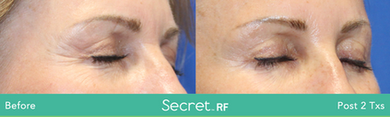 Secret RF Before & Afters
(Images courtesy Cutera)