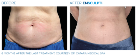 Emsculpt_Neo_PIC_Ba-card-female-abdomen-139_ENUS100.png