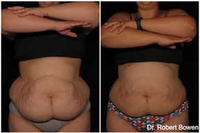 Liposuction by Dr. Robert Bowen in Martinsburg, WV