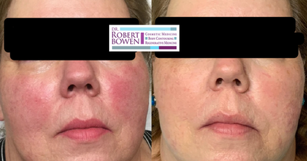 BBL Before & After by Dr. Robert Bowen