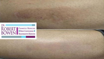 BBL Before & After by Dr. Robert Bowen