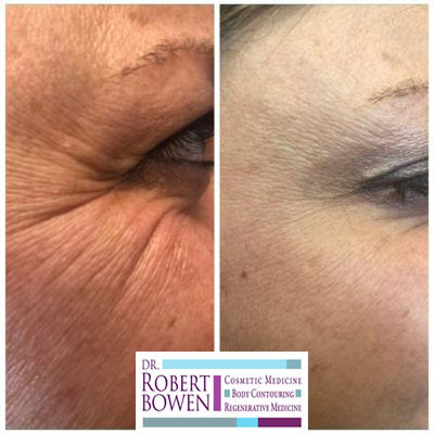 'Tox' wrinkle-reducing injection Before & After by Dr. Robert Bowen