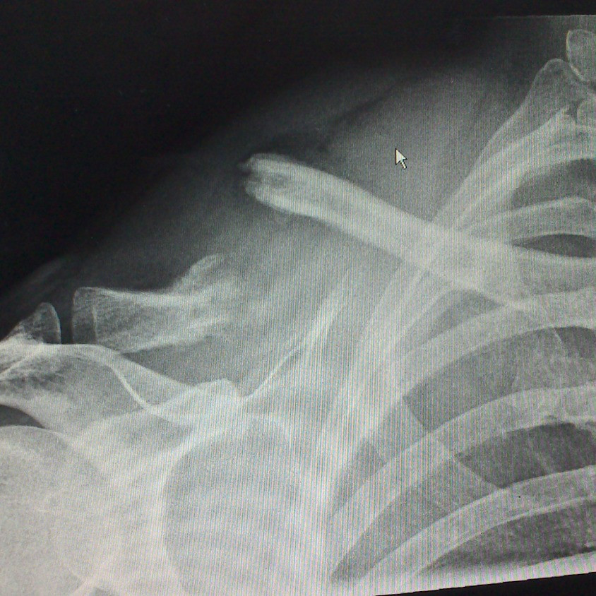 Mark Allen's fractured collarbone prior to surgical plating