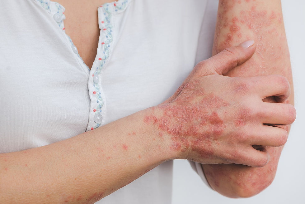 Personne présentant des problèmes de psoriasis