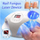 Miniatúra: 2-in-1 Fungal Nail Laser Device Toenail Fungus Repair Onychomycosis Foot Care