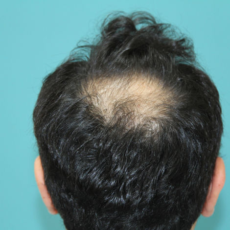 Dr Raghu Reddy - Restore Hair Clinics