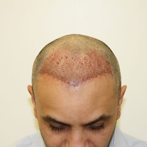 Dr Raghu Reddy - Restore Hair Clinics