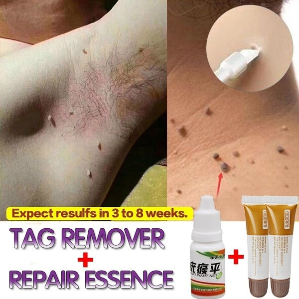 cópia de Professional Skin Tag Remover Warts Foot Corn Remover 10ml + High Quali