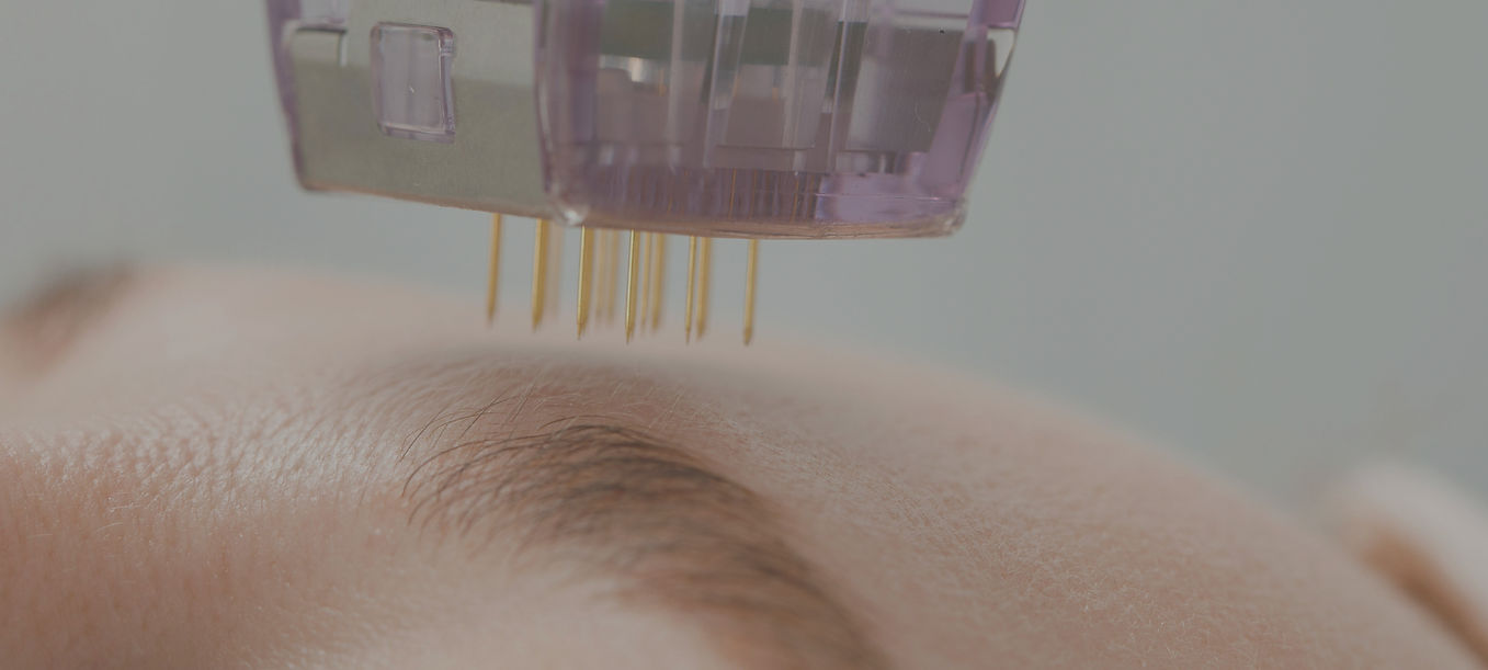 Perawatan Melasma Only at Perawatan Acne Scar Only at SAÉ Clinique Beauty & Wellness Gading Serpong, Tangerang