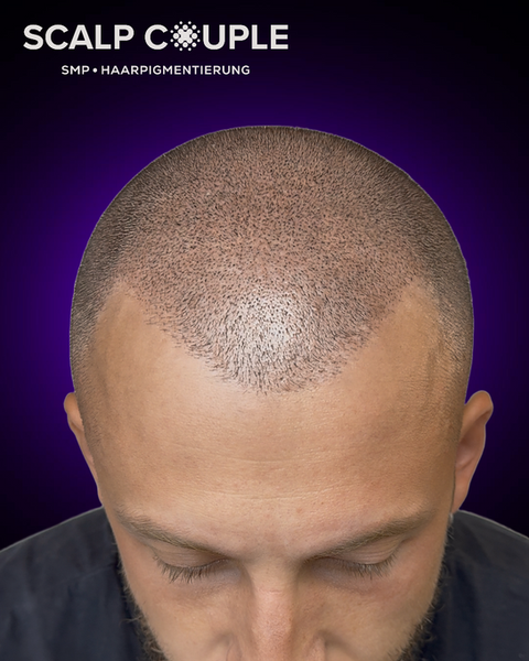 Haarpigmentierung bei Männer mit Geheimratsecken und Haarausfall