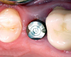 Biomet 3i Dental Implants