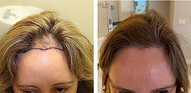 Hair transplant for women before after