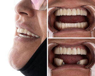 Lower arch implants and smile design