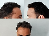 Hairline transplant planning