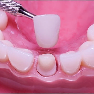 Dental crowns explained