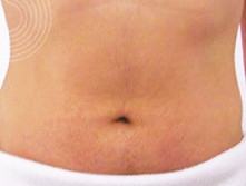 BAS04 cryoliposculpt