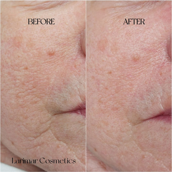 Vorher-Nachher Gesichtsbehandlung: Faltenreduktion